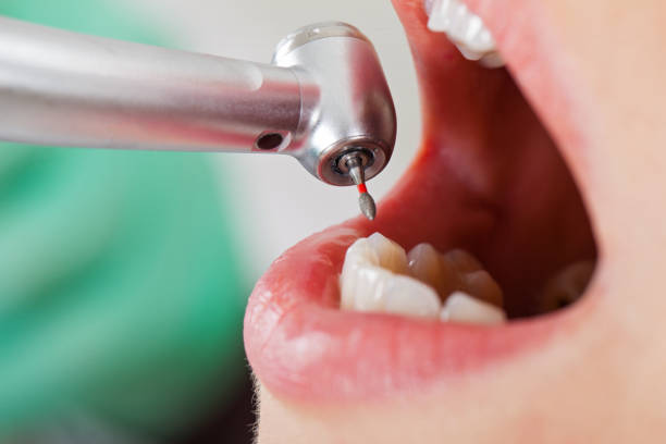 Best Broken or Chipped Tooth Repair in Blennerhassett, WV